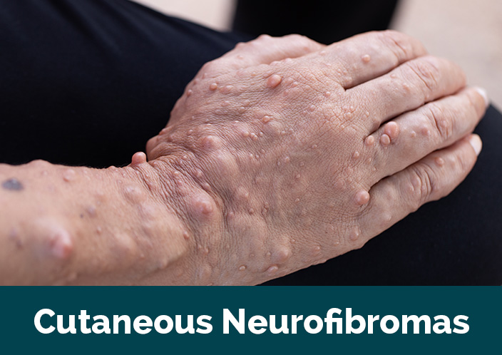 images/Featured-Studies/Cutaneous-Neurofibromas-clinical-trial-education-research-foundation-lynchburg.jpg#joomlaImage://local-images/Featured-Studies/Cutaneous-Neurofibromas-clinical-trial-education-research-foundation-lynchburg.jpg?width=704&height=498
