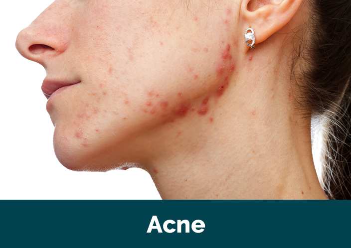 images/Featured-Studies/acne-medical-study-lynchburg-va-education-research-foundation.jpg#joomlaImage://local-images/Featured-Studies/acne-medical-study-lynchburg-va-education-research-foundation.jpg?width=704&height=498